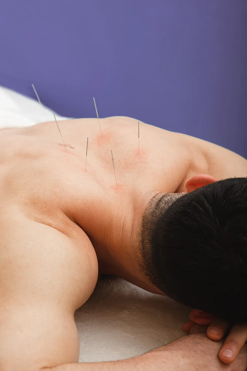 Man receiving acupuncture along the upper back and shoulder