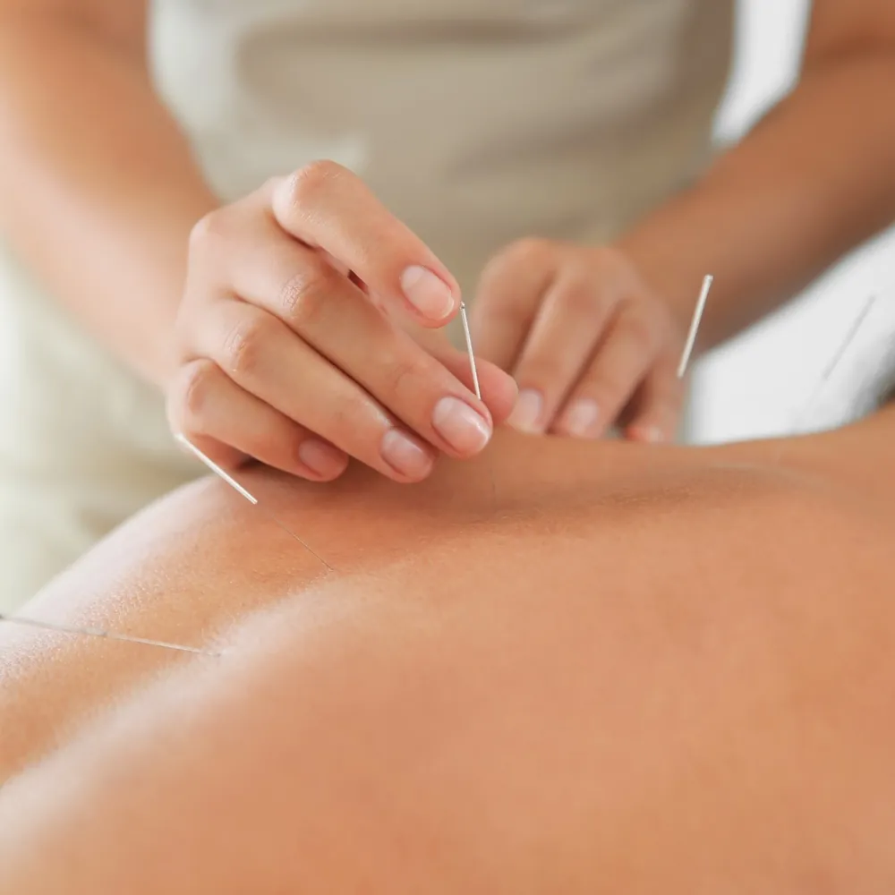 Acupuncturist placing needles along a patient's upper back at the Silver Lake clinic in Los Angeles.