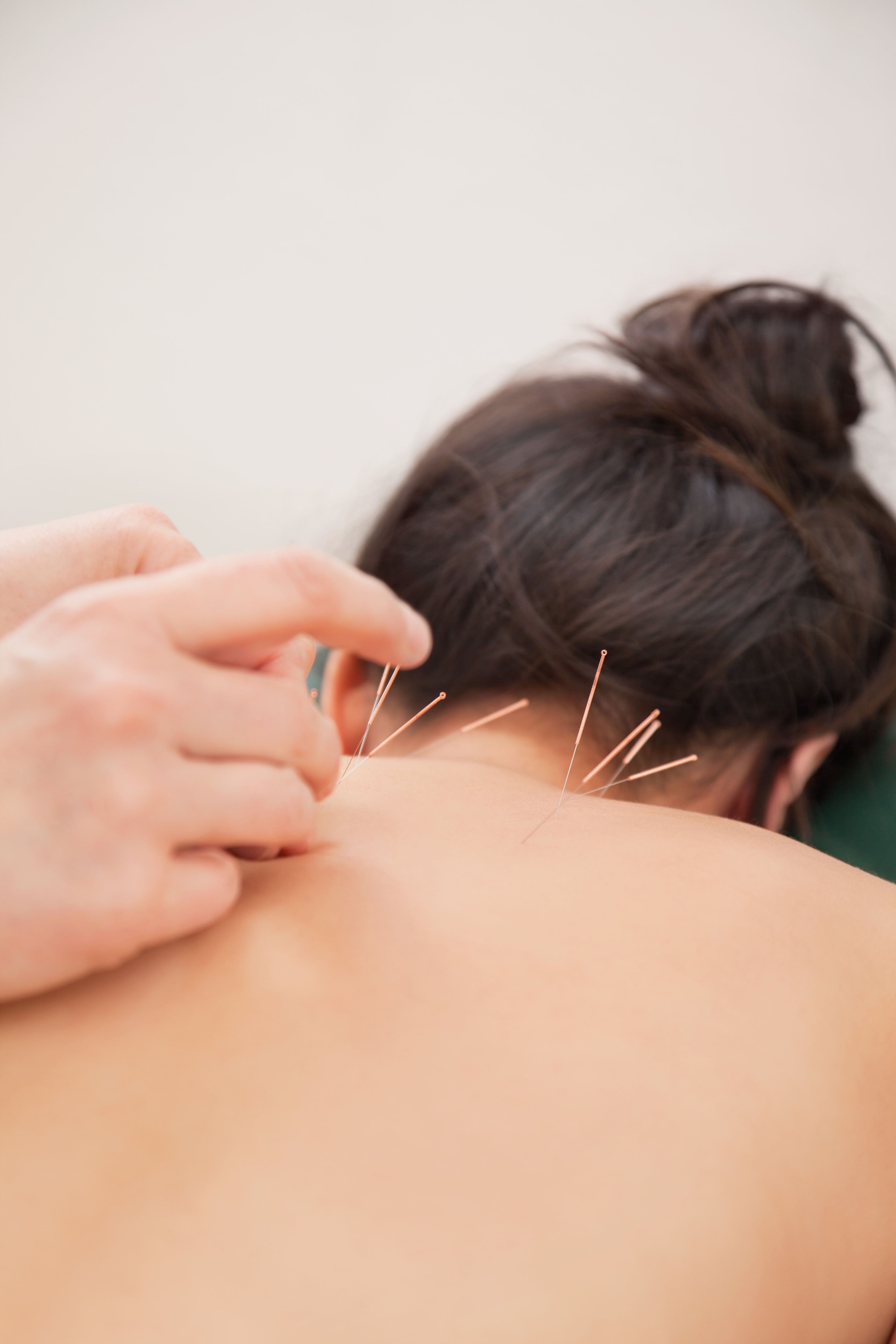 Pain relief acupuncture