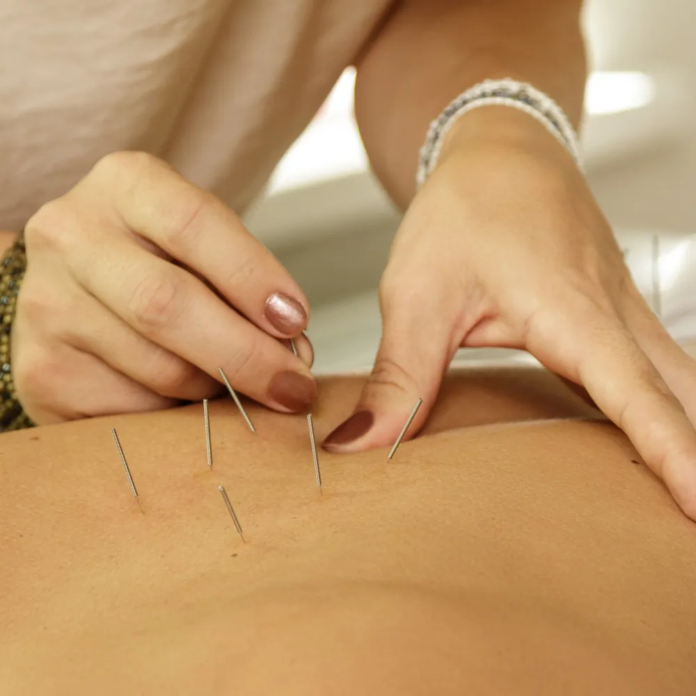 Acupuncturist placing needles along a patient's back during a digestive health treatment