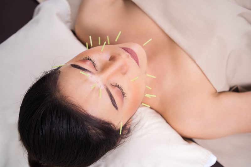 Woman resting with her eyes closed while acupuncture needles are placed on her face and neck