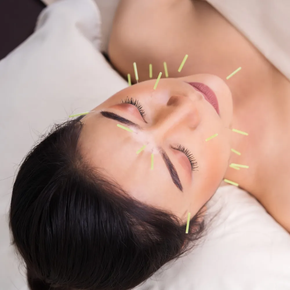 Woman resting with her eyes closed while acupuncture needles are placed on her face and neck