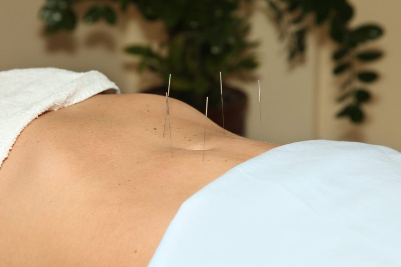Acupuncture needles placed along a patient's lower abdomen during a women's health treatment