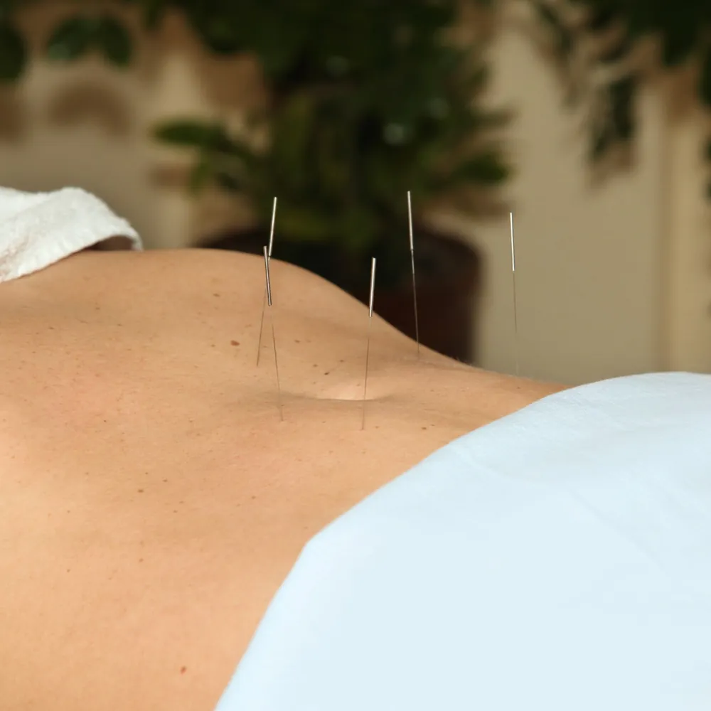 Acupuncture needles placed along a patient's lower abdomen during a women's health treatment